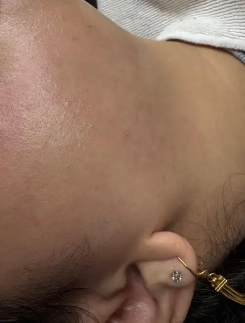 After dermaplaning treatment showing smooth skin results Royal Glow Beauty