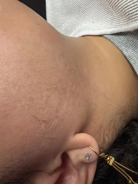 Before dermaplaning treatment showing peach fuzz and texture Royal Glow Beauty