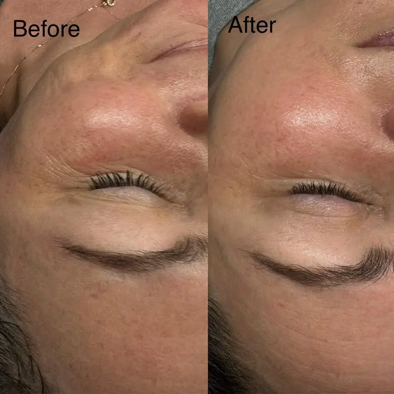 Before and after facials near me in Boardman showing smoother cheeks and reduced fine lines