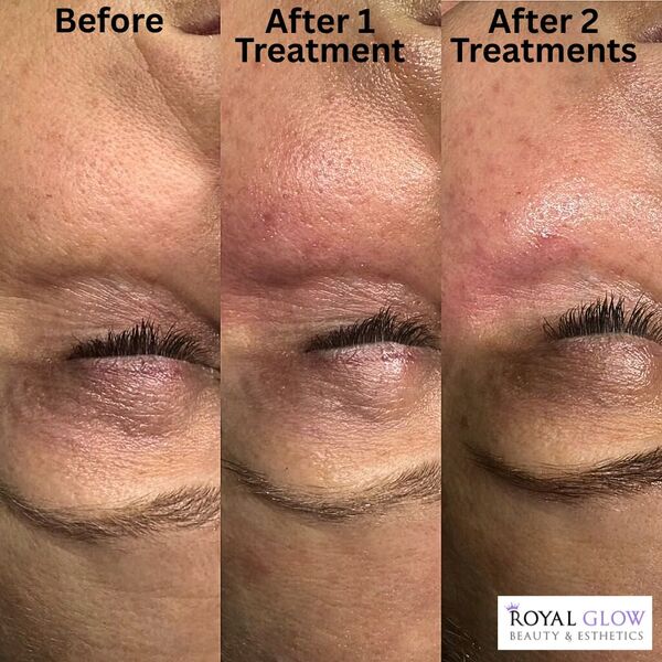 Anti-aging facial ReZenerate nanotechnology Royal Glow Beauty Esthetics Boardman Ohio
