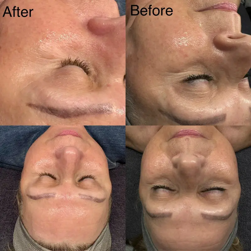 ReZENerate Nano Facial treatment - one of our best facials near me in Boardman, Ohio